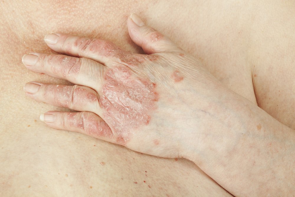 What is Psoriatic Arthritis?
